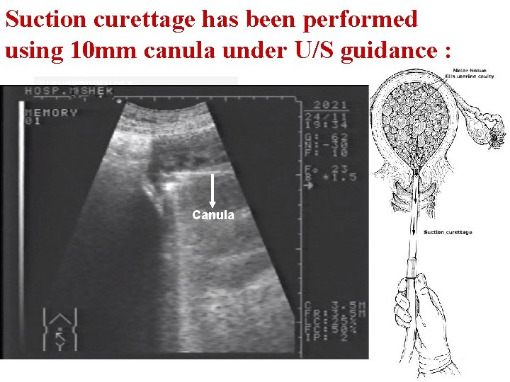 Suction curettage has been performed using 10 mm canula under U/S guidance : El