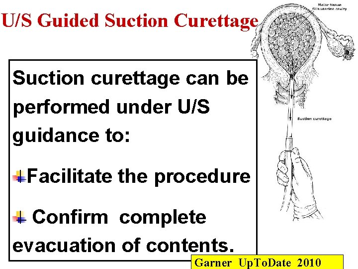 U/S Guided Suction Curettage Suction curettage can be performed under U/S guidance to: Facilitate