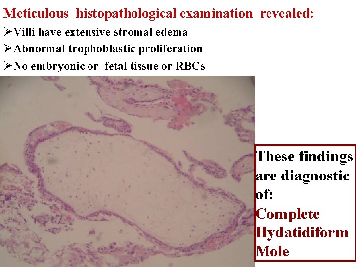 Meticulous histopathological examination revealed: ØVilli have extensive stromal edema ØAbnormal trophoblastic proliferation ØNo embryonic
