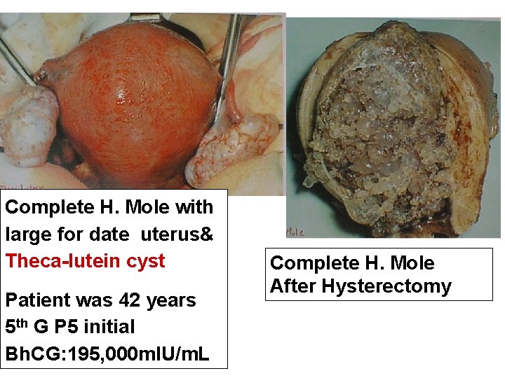 Complete H. Mole with large for date uterus& Theca-lutein cyst Patient was 42 years