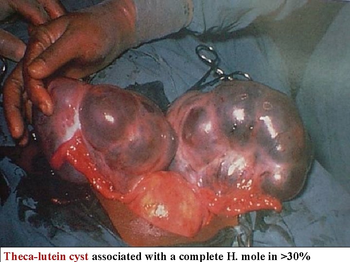 Theca-lutein cyst associated with a complete H. mole in >30% 