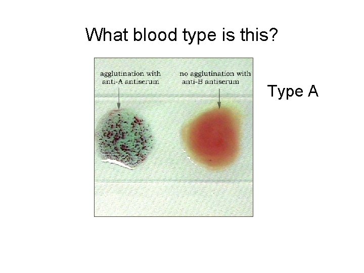 What blood type is this? Type A 