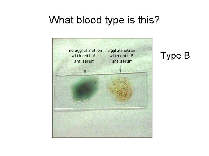 What blood type is this? Type B 