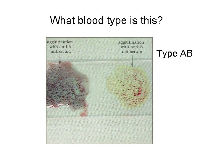 What blood type is this? Type AB 