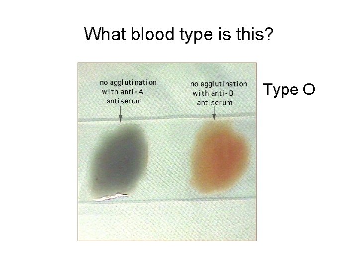 What blood type is this? Type O 