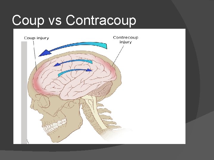 Coup vs Contracoup 