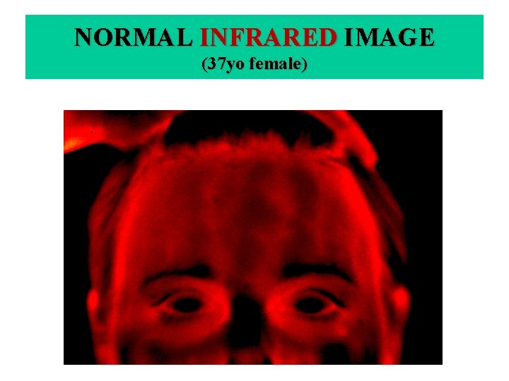NORMAL INFRARED IMAGE (37 yo female) 
