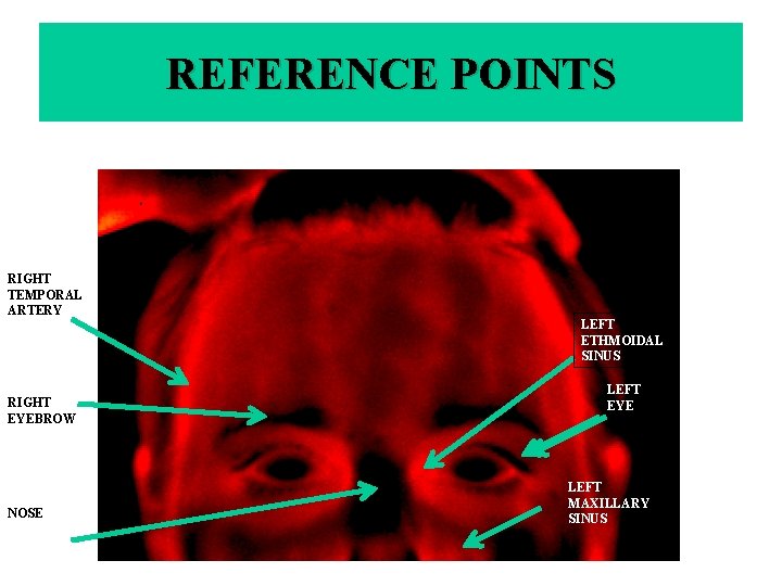 REFERENCE POINTS RIGHT TEMPORAL ARTERY RIGHT EYEBROW NOSE LEFT ETHMOIDAL SINUS LEFT EYE LEFT