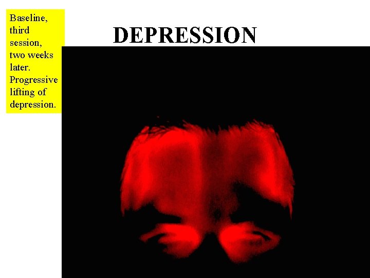 Baseline, third session, two weeks later. Progressive lifting of depression. DEPRESSION 