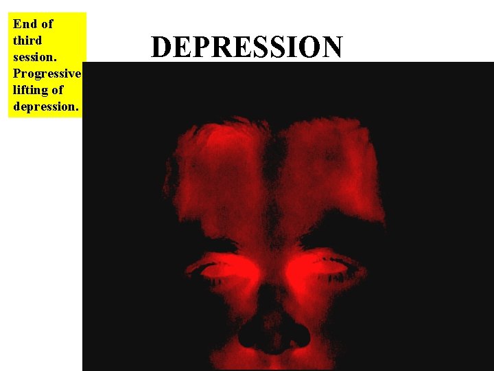 End of third session. Progressive lifting of depression. DEPRESSION 