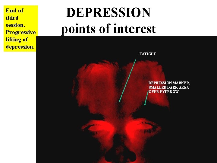 End of third session. Progressive lifting of depression. DEPRESSION points of interest FATIGUE DEPRESSION