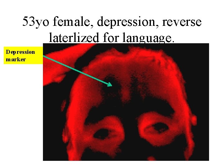 53 yo female, depression, reverse laterlized for language. Depression marker 