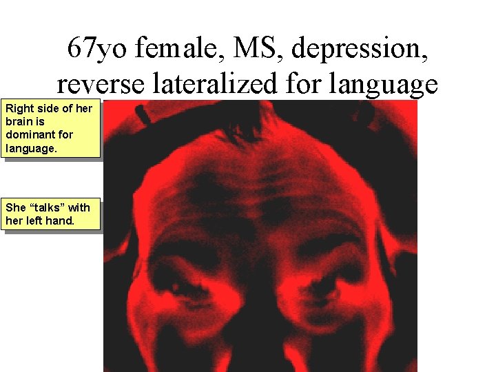 67 yo female, MS, depression, reverse lateralized for language Right side of her brain