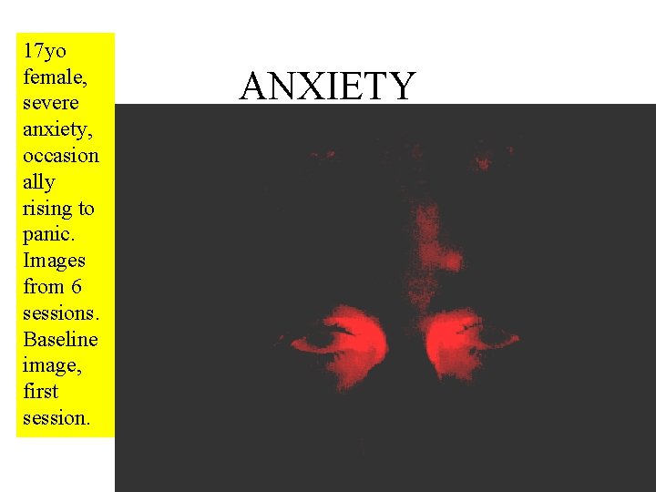 17 yo female, severe anxiety, occasion ally rising to panic. Images from 6 sessions.
