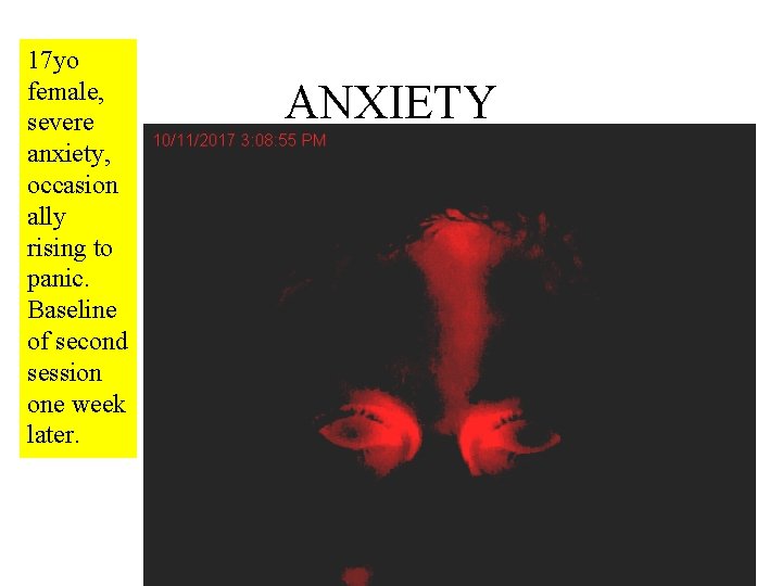 17 yo female, severe anxiety, occasion ally rising to panic. Baseline of second session