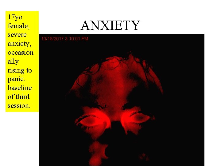 17 yo female, severe anxiety, occasion ally rising to panic. baseline of third session.