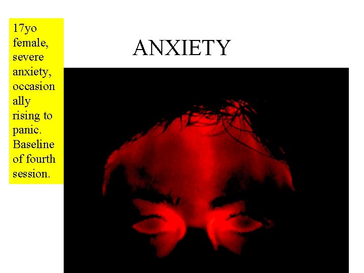 17 yo female, severe anxiety, occasion ally rising to panic. Baseline of fourth session.