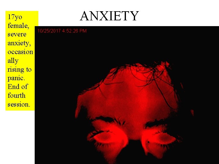 17 yo female, severe anxiety, occasion ally rising to panic. End of fourth session.