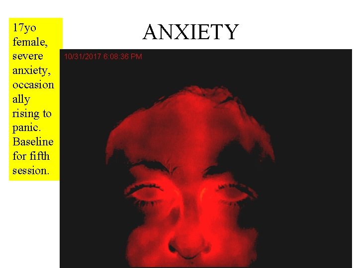 17 yo female, severe anxiety, occasion ally rising to panic. Baseline for fifth session.
