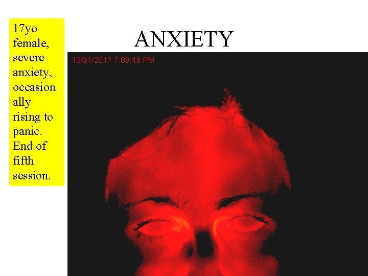 17 yo female, severe anxiety, occasion ally rising to panic. End of fifth session.