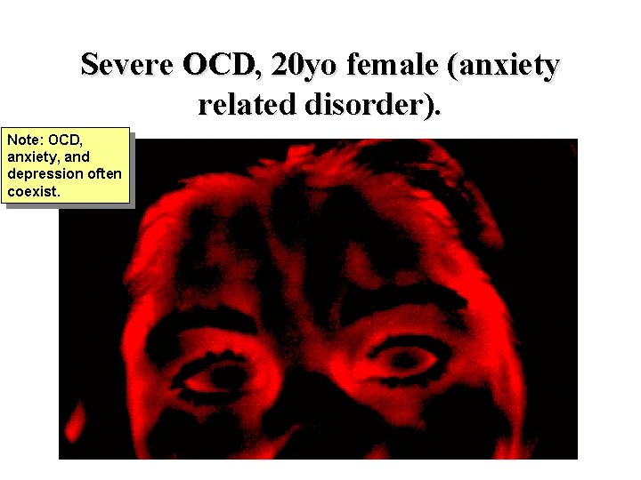Severe OCD, 20 yo female (anxiety related disorder). Note: OCD, anxiety, and depression often