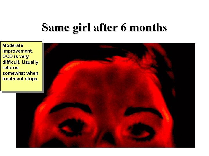 Same girl after 6 months Moderate improvement. OCD is very difficult. Usually returns somewhat