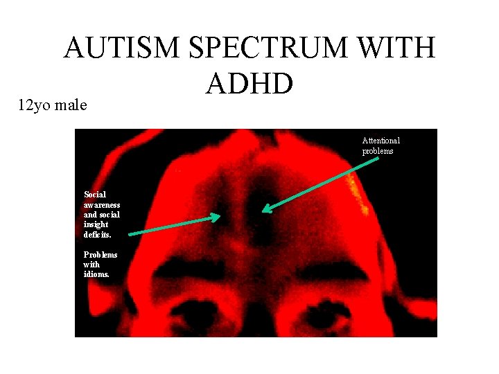 AUTISM SPECTRUM WITH ADHD 12 yo male Attentional problems Social awareness and social insight