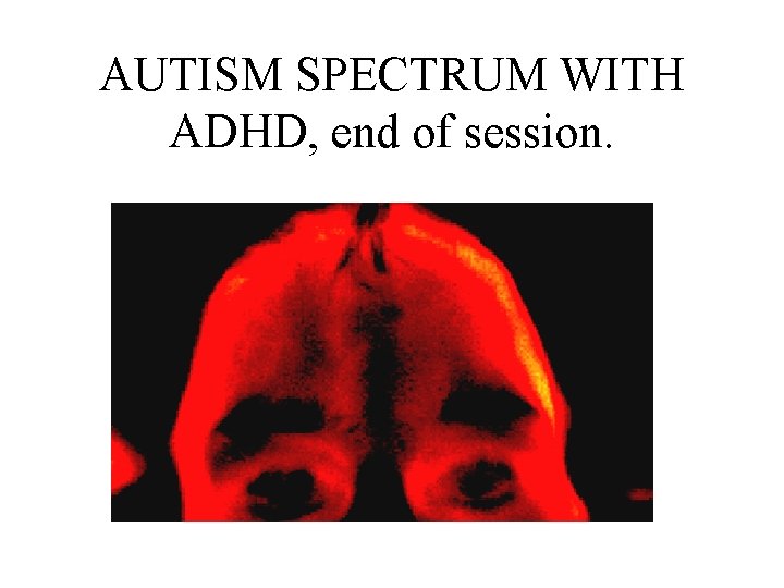 AUTISM SPECTRUM WITH ADHD, end of session. 