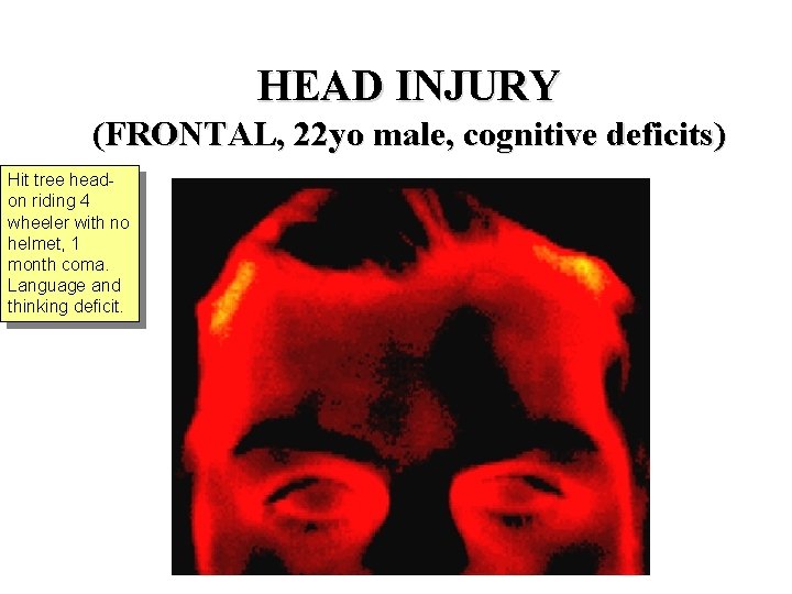 HEAD INJURY (FRONTAL, 22 yo male, cognitive deficits) Hit tree headon riding 4 wheeler