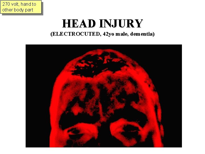 270 volt, hand to other body part HEAD INJURY (ELECTROCUTED, 42 yo male, dementia)