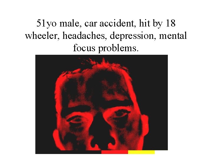 51 yo male, car accident, hit by 18 wheeler, headaches, depression, mental focus problems.