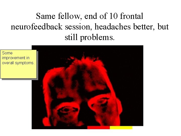 Same fellow, end of 10 frontal neurofeedback session, headaches better, but still problems. Some