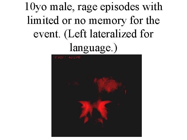 10 yo male, rage episodes with limited or no memory for the event. (Left