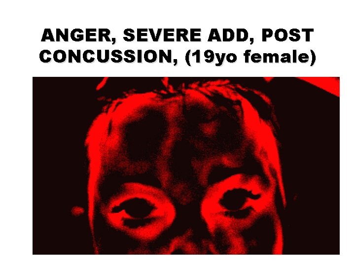 ANGER, SEVERE ADD, POST CONCUSSION, (19 yo female) 