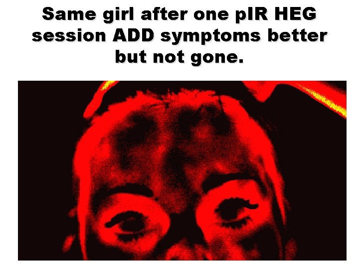 Same girl after one p. IR HEG session ADD symptoms better but not gone.