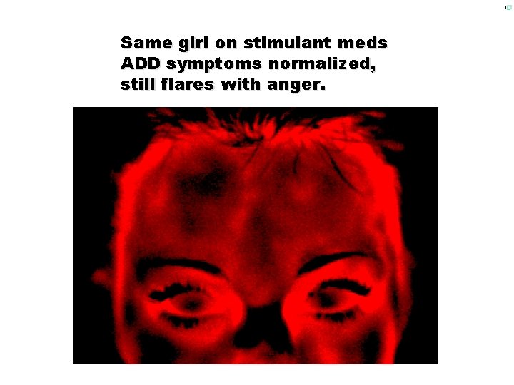 � Same girl on stimulant meds ADD symptoms normalized, still flares with anger. 