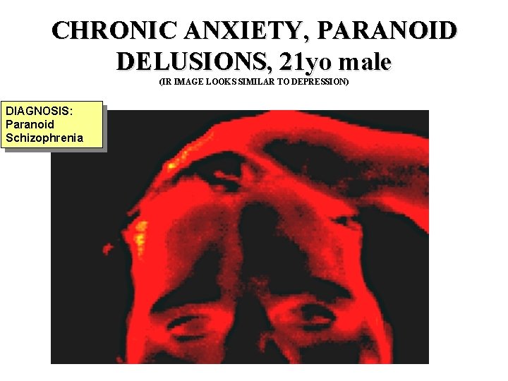 CHRONIC ANXIETY, PARANOID DELUSIONS, 21 yo male (IR IMAGE LOOKS SIMILAR TO DEPRESSION) DIAGNOSIS:
