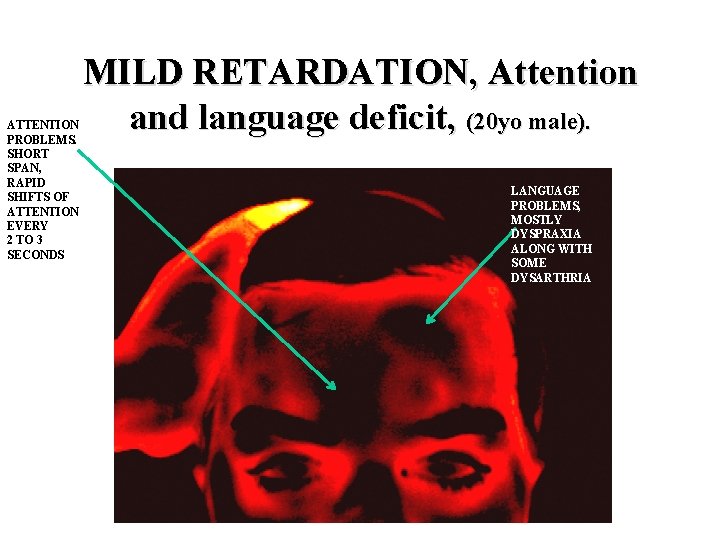 ATTENTION PROBLEMS. SHORT SPAN, RAPID SHIFTS OF ATTENTION EVERY 2 TO 3 SECONDS MILD