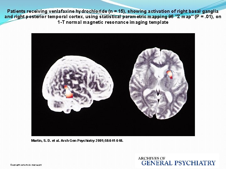 Patients receiving venlafaxine hydrochloride (n = 15), showing activation of right basal ganglia and