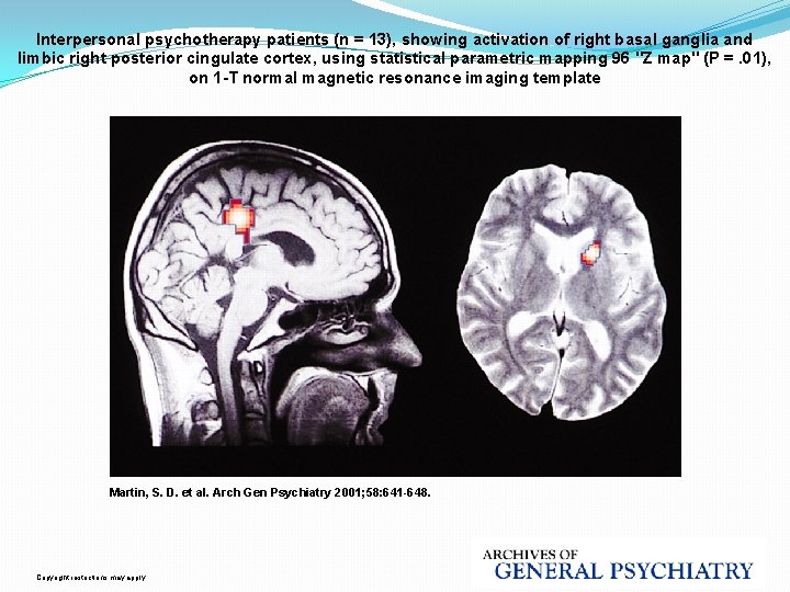 Interpersonal psychotherapy patients (n = 13), showing activation of right basal ganglia and limbic