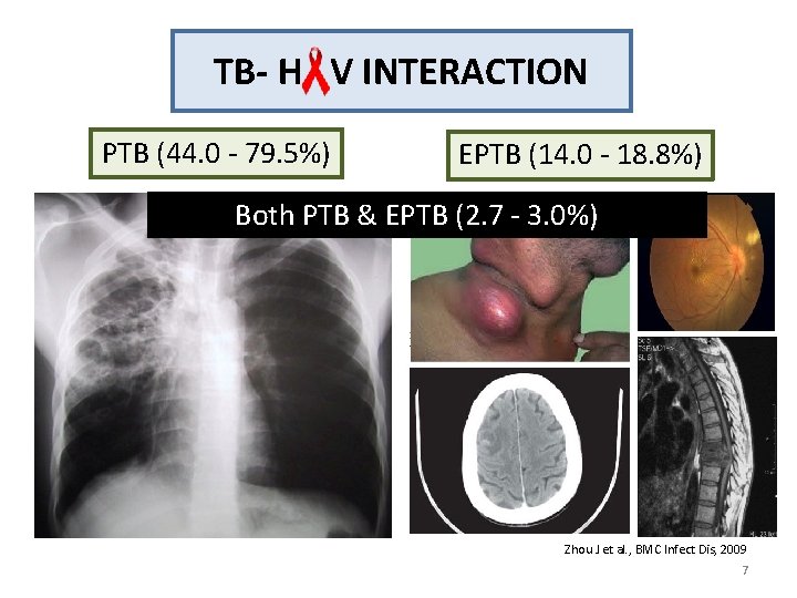 TB- H V INTERACTION PTB (44. 0 - 79. 5%) EPTB (14. 0 -