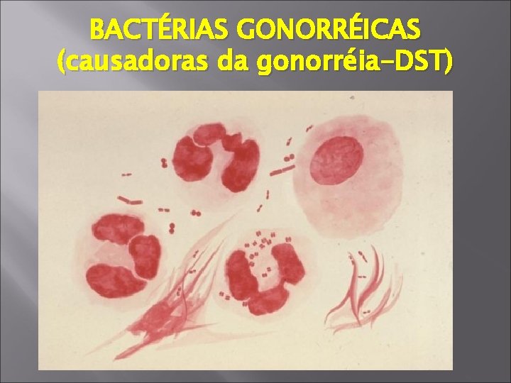 BACTÉRIAS GONORRÉICAS (causadoras da gonorréia-DST) 