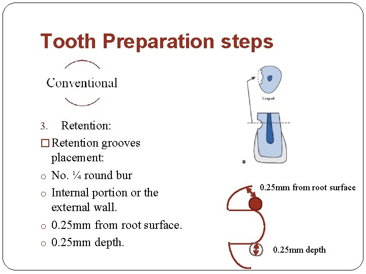 Tooth Preparation steps Retention: � Retention grooves placement: o No. ¼ round bur o