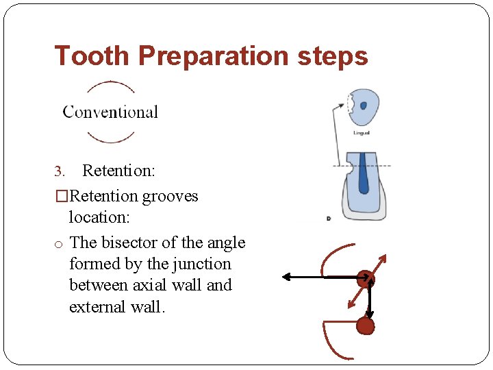 Tooth Preparation steps Retention: �Retention grooves location: o The bisector of the angle formed