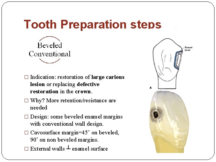Tooth Preparation steps � Indication: restoration of large carious lesion or replacing defective restoration