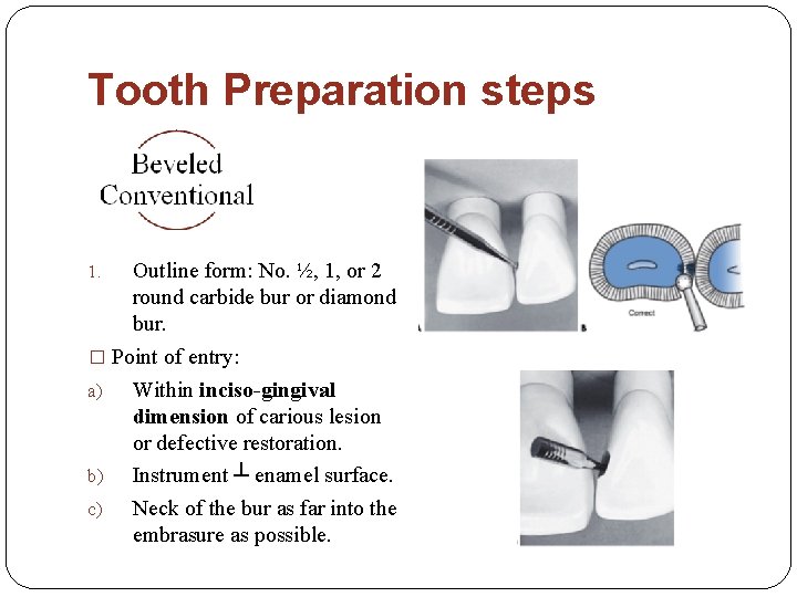 Tooth Preparation steps Outline form: No. ½, 1, or 2 round carbide bur or