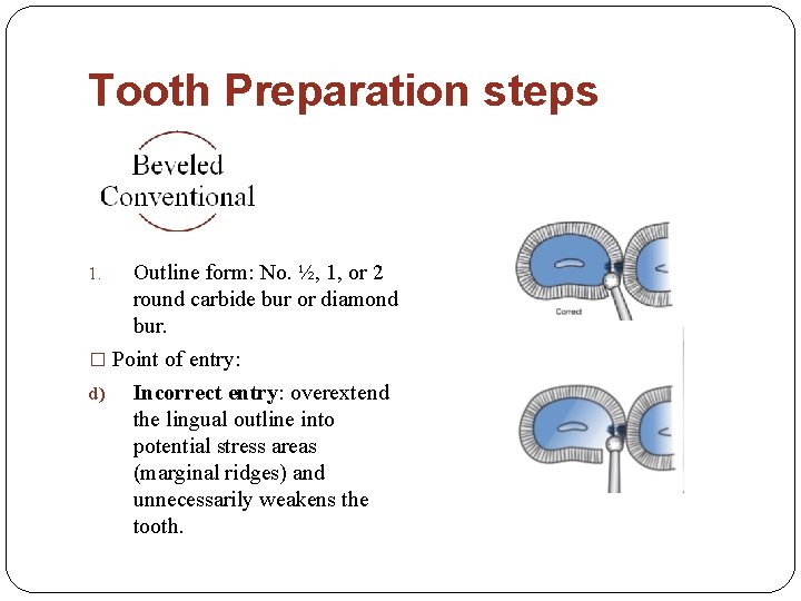 Tooth Preparation steps Outline form: No. ½, 1, or 2 round carbide bur or