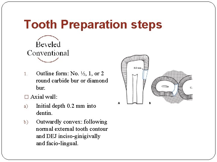 Tooth Preparation steps Outline form: No. ½, 1, or 2 round carbide bur or