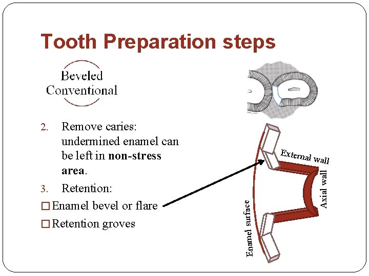 Tooth Preparation steps Remove caries: undermined enamel can be left in non-stress area. 3.