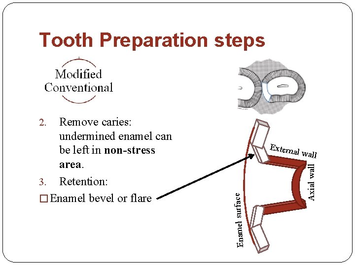 Tooth Preparation steps Remove caries: undermined enamel can be left in non-stress area. 3.